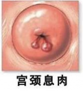 徐州哪里治疗宫颈疾病效果比较好？